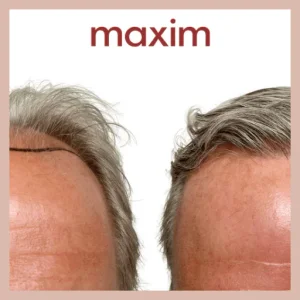 Maxim Hair Restoration & Transplants